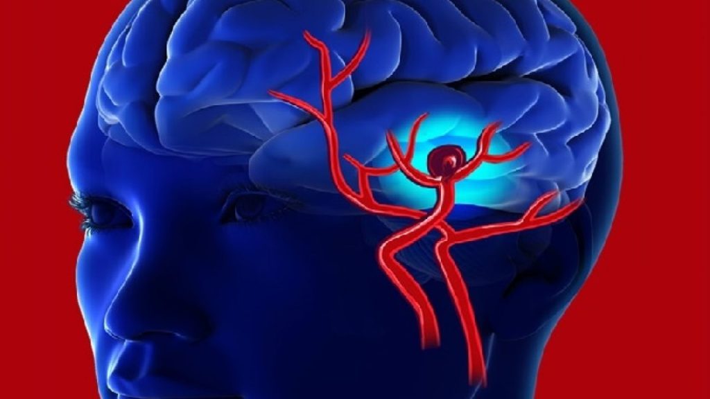 Όσα πρέπει να ξέρετε για το ανεύρυσμα εγκεφάλου: Τα συμπτώματα ενός μη ραγισμένου ανευρύσματος