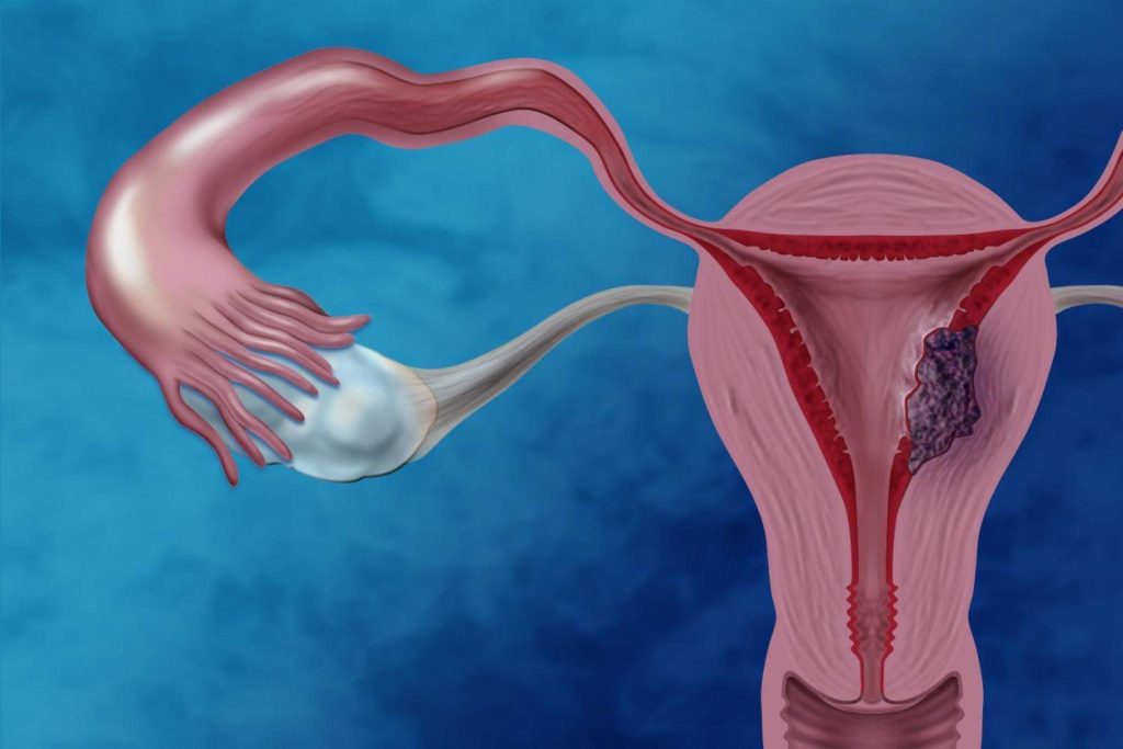 Καρκίνος του ενδομητρίου: Αίτια, συμπτώματα και παράγοντες κινδύνου