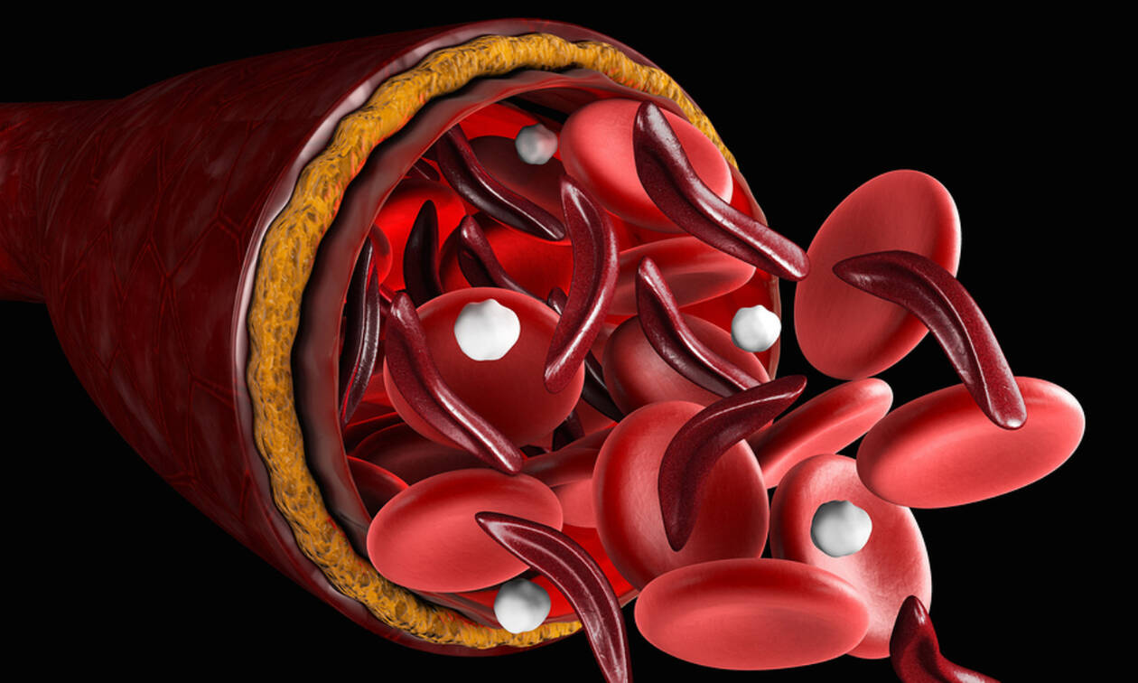 Αυτά είναι τα τα 8 βασικότερα συμπτώματα της έλλειψης σιδήρου