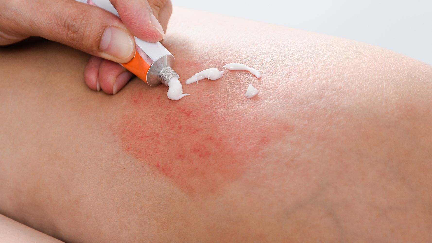 Προσοχή στα δερματικά προβλήματα που προκαλούνται λόγω άγχους και στρες – Πώς να τα αντιμετωπίσετε