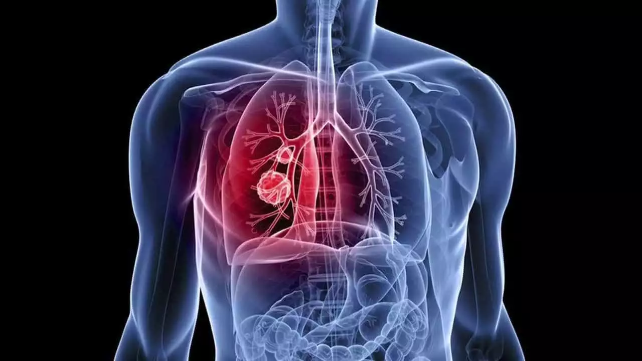 Καρκίνος του πνεύμονα: Πρώιμο σύμπτωμα η ασυνήθιστη βραχνάδα στη φωνή