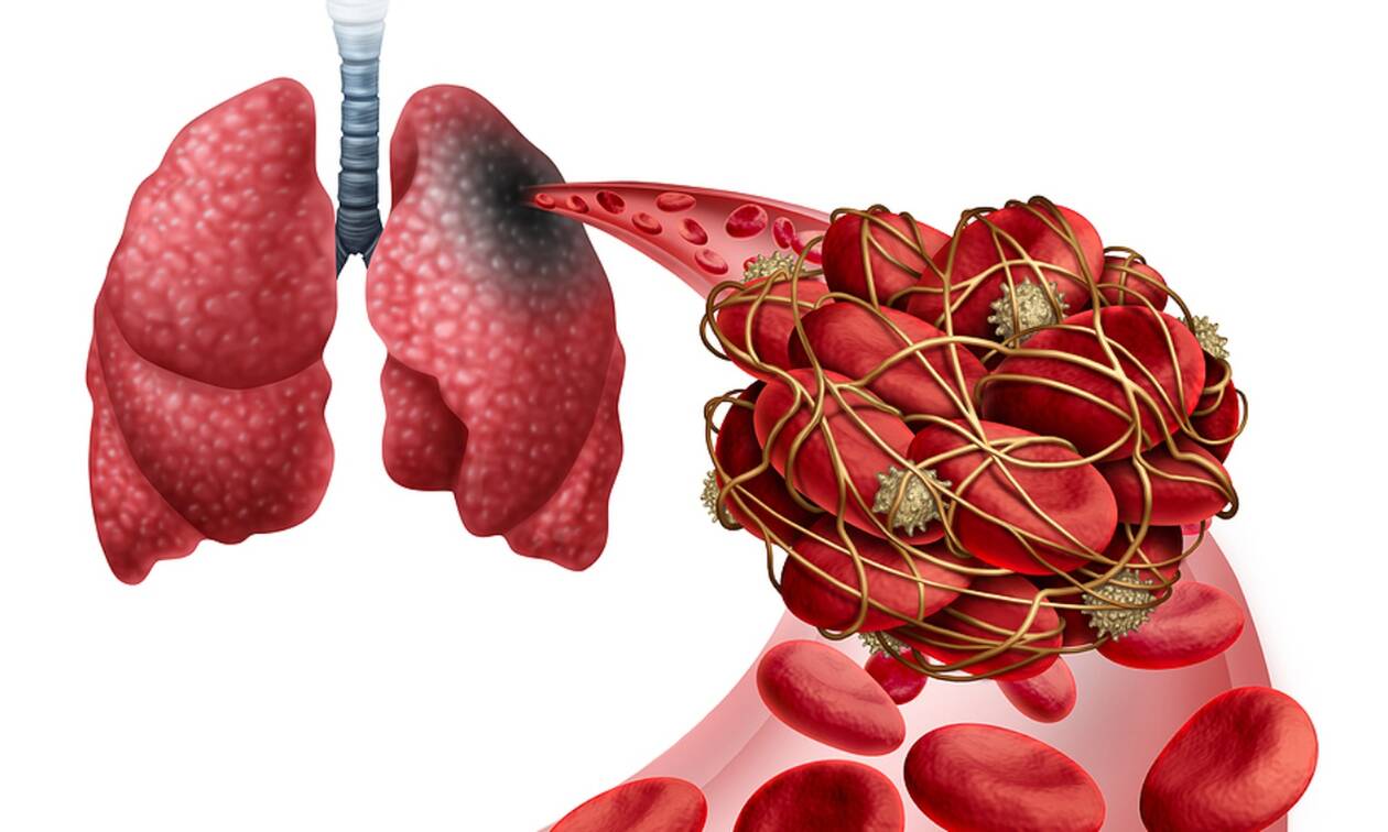 Πνευμονική εμβολή: Τα συμπτώματα πού χρειάζονται προσοχή – Οι παράγοντες κινδύνου