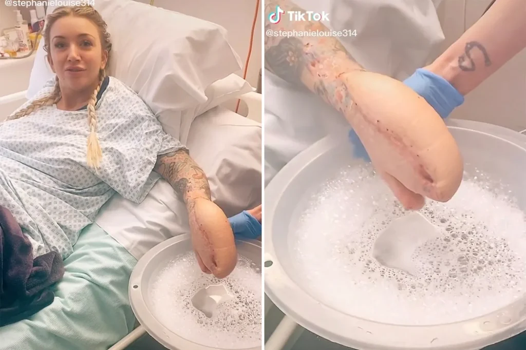 Βρετανία: 34χρονη πήγε για μία εγχείρηση στα νεφρά και όταν ξύπνησε το χέρι της έμοιαζε με… καρχαρία! (βίντεο)