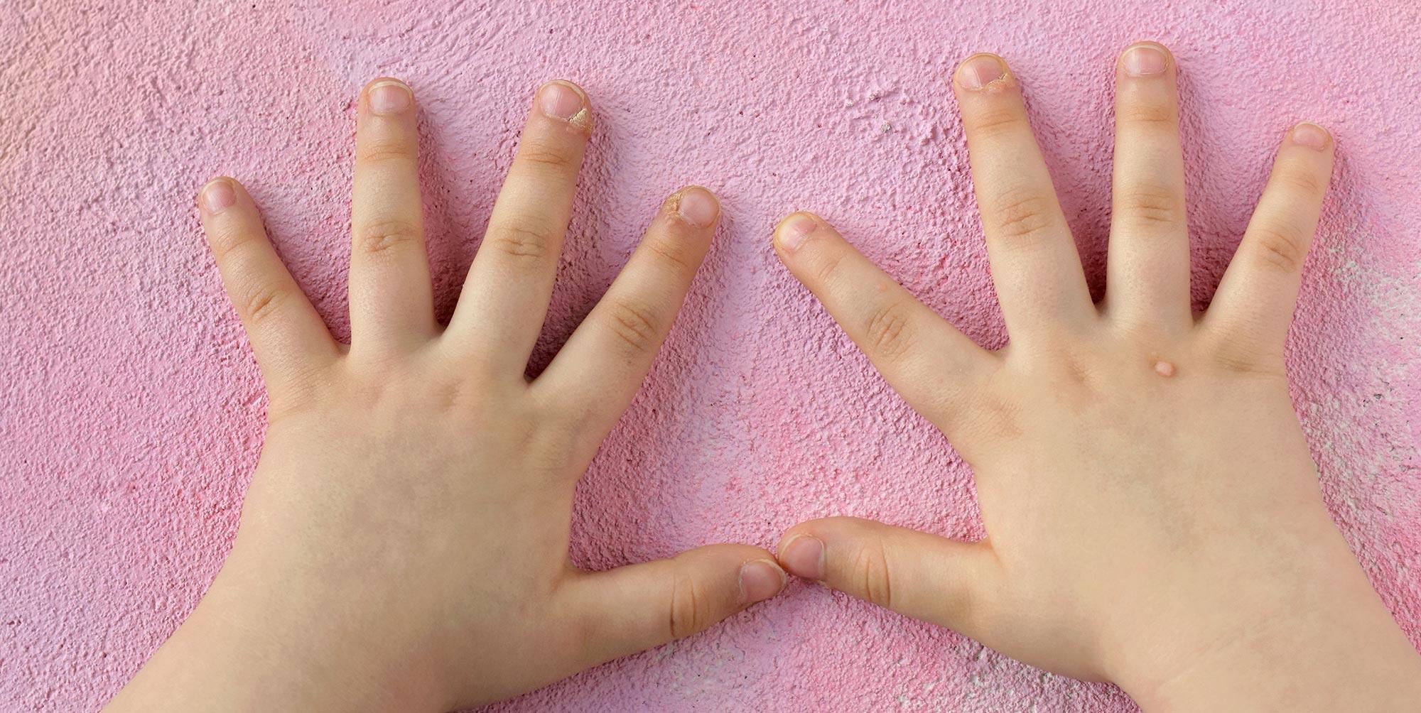 Όσα πρέπει να ξέρετε για τη μολυσματική τέρμινθο – Συμπτώματα, μετάδοση & πρόληψη