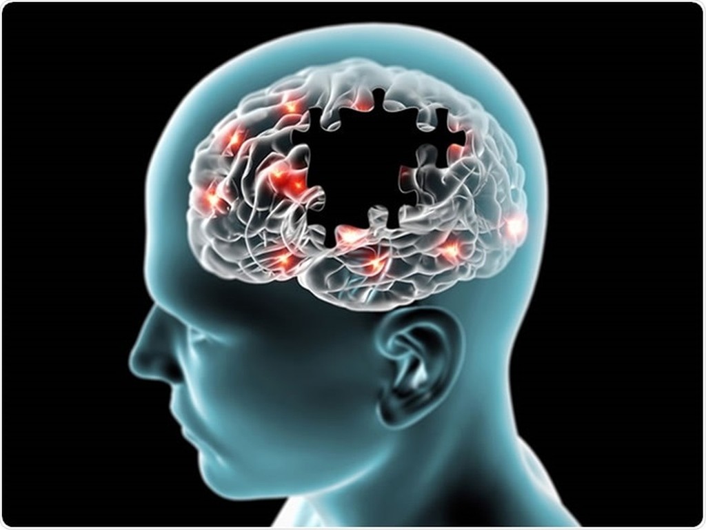 Νέα έρευνα: Η απώλεια συγκεκριμένων νευρώνων του εγκεφάλου κάνει ληθαργικούς τους ασθενείς με Αλτσχάιμερ