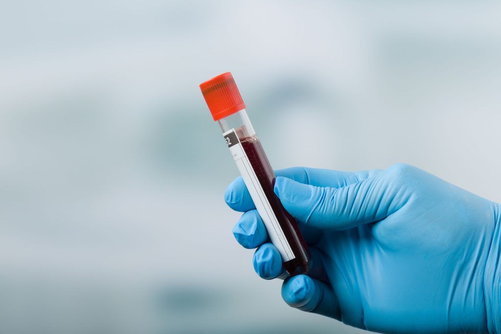 Ανακαλύφθηκε νέο τεστ αίματος που προβλέπει τον κίνδυνο εμφράγματος και εγκεφαλικού