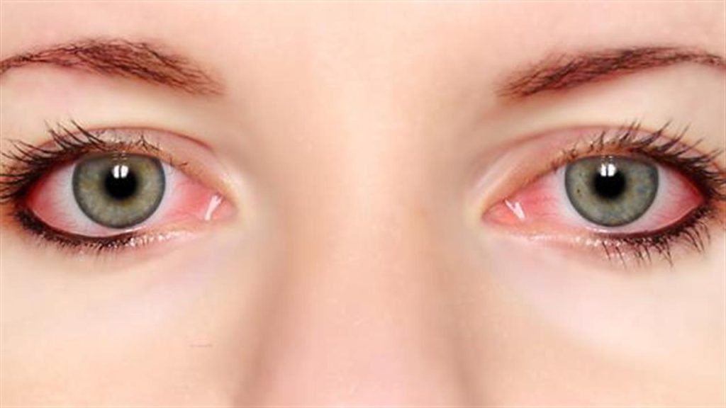 Όσα πρέπει να ξέρετε για την αλλεργία στα μάτια – Πώς να αντιμετωπίσετε φαγούρα, κοκκίνισμα & δάκρυα