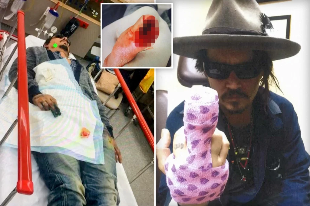 Τζόνι Ντεπ: Σοκάρουν οι ανατριχιαστικές φωτογραφίες με το κομμένο δάχτυλο μετά από καβγά με την Α.Χερντ