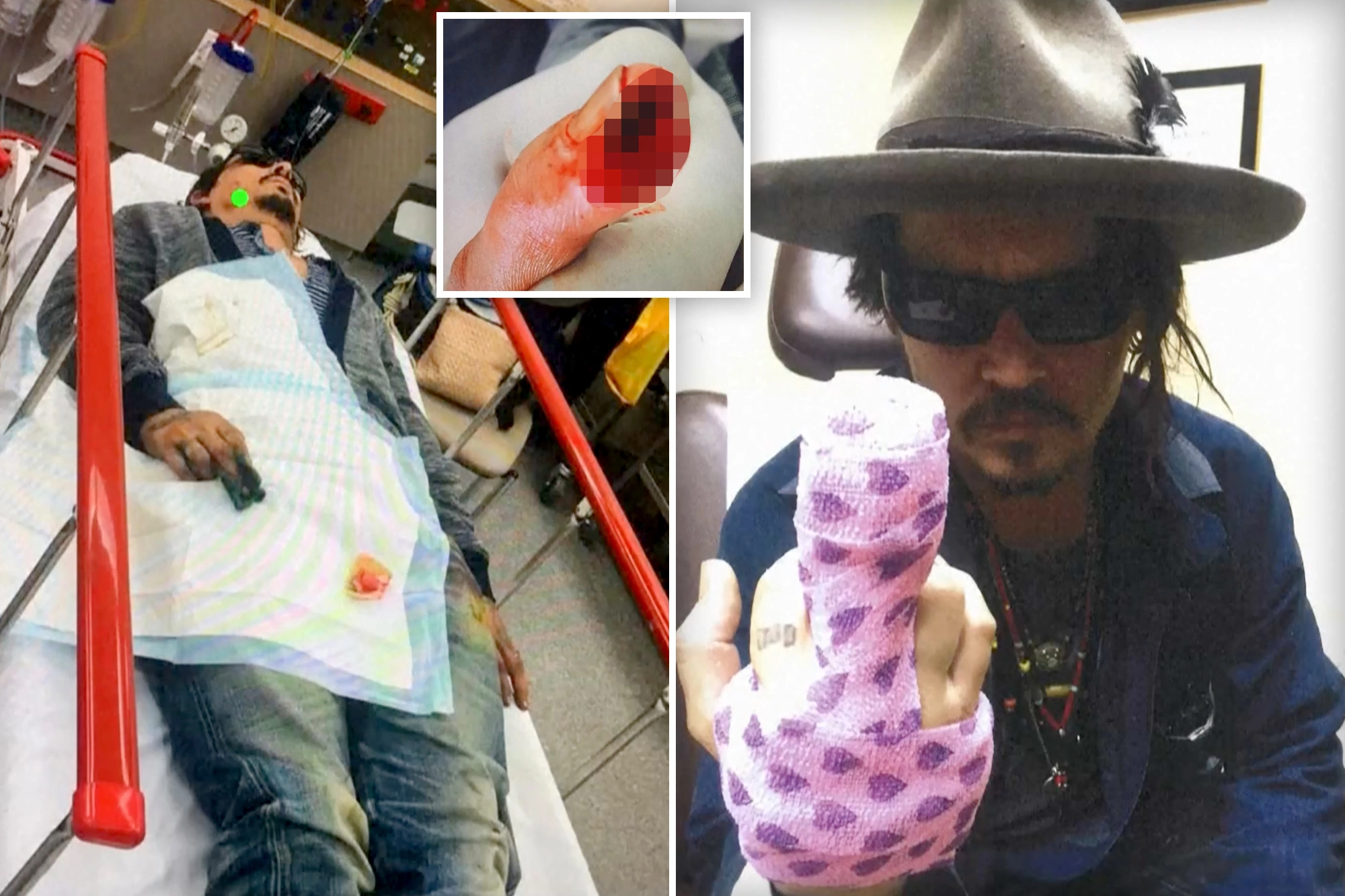 Τζόνι Ντεπ: Σοκάρουν οι ανατριχιαστικές φωτογραφίες με το κομμένο δάχτυλο μετά από καβγά με την Α.Χερντ