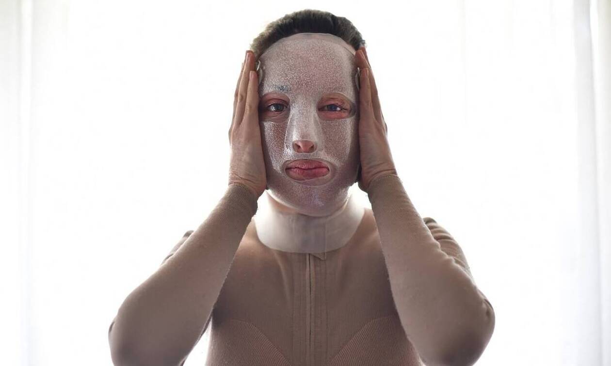 Γιατρός Ιωάννας Παλιοσπύρου: «Το έγκαυμά της ίσως είναι το μεγαλύτερο παγκοσμίως»