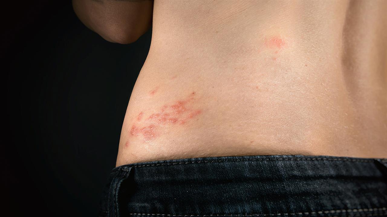 Έρπης ζωστήρας: Τι ρόλο παίζει ο κορωνοϊός στην ανάπτυξή του – Τι έδειξε μελέτη