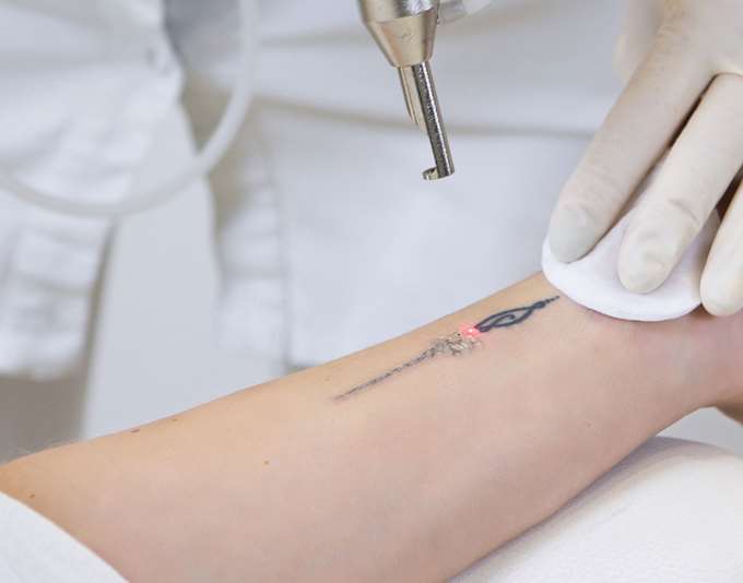 Προσοχή: Η αφαίρεση τατουάζ με λέιζερ μπορεί να προκαλέσει φουσκάλες στο δέρμα