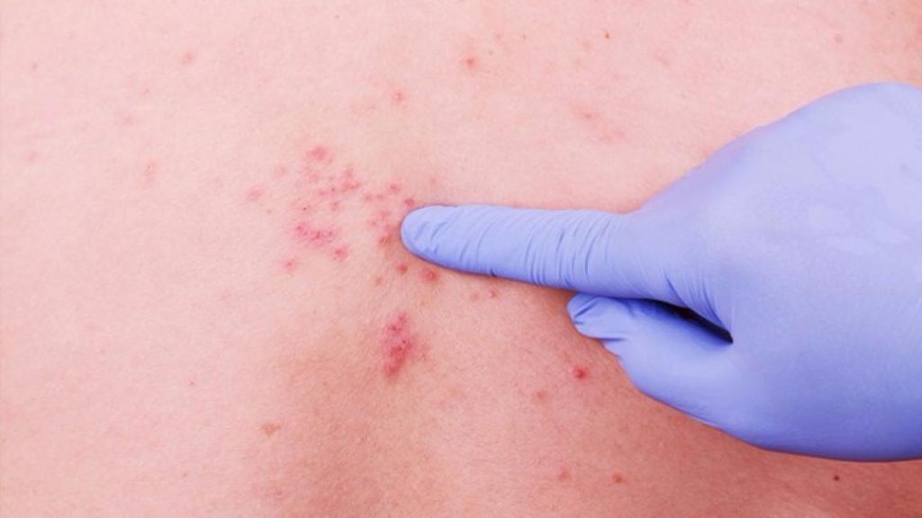 Έρπης ζωστήρας: Αιτίες και ποια τα συμπτώματα που θα νιώσετε