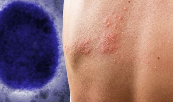 Γερμανία: Ανακοινώθηκε το πρώτο κρούσμα ευλογιάς των πιθήκων