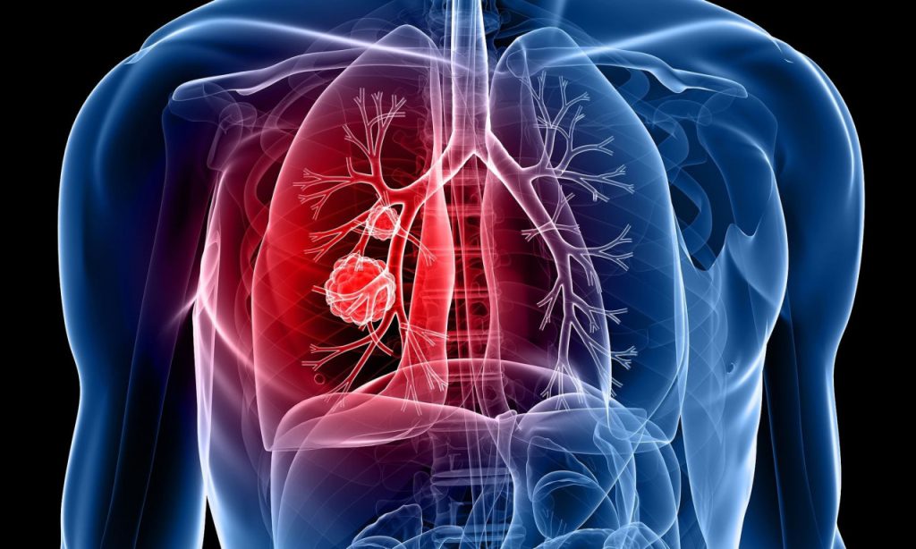 Καρκίνος των πνευμόνων: Συμπτώματα, αιτίες & παράγοντες κινδύνου – Ποιοι κινδυνεύουν περισσότερο