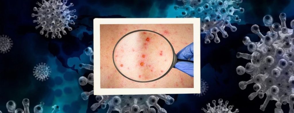 ΠΟΥ για ευλογιά των πιθήκων: «Δεν έχουν παρατηρηθεί μεταλλάξεις του ιού»