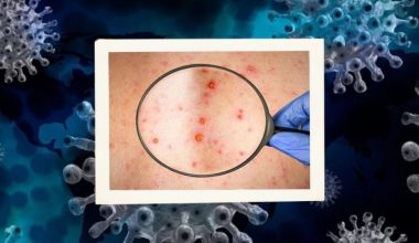 ΠΟΥ για ευλογιά των πιθήκων: «Δεν έχουν παρατηρηθεί μεταλλάξεις του ιού»