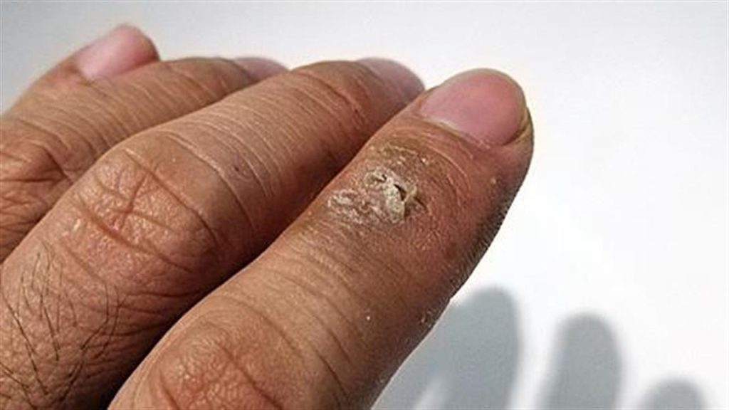 Τέσσερα δερματικά συμπτώματα που μπορεί να οφείλονται σε πρόβλημα στους πνεύμονες