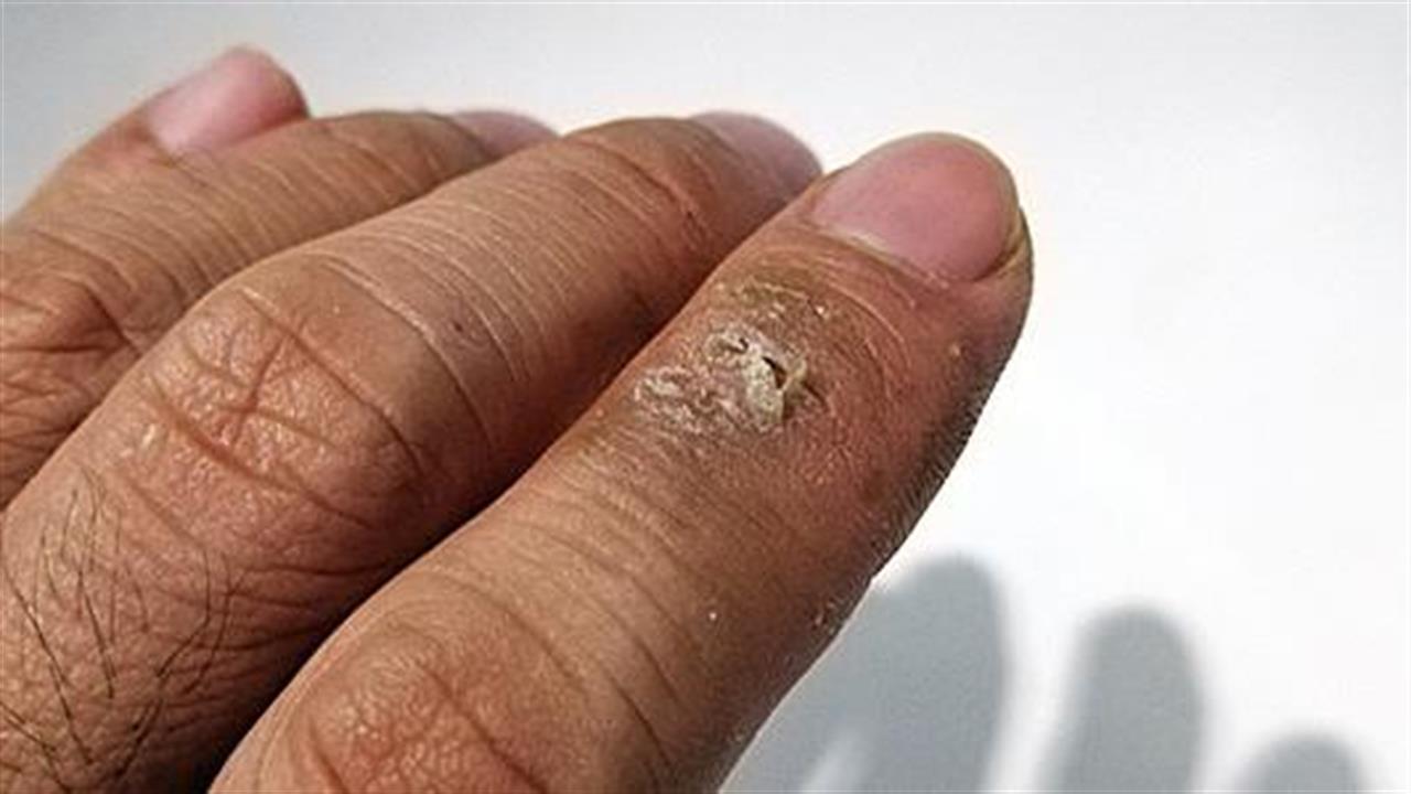 Τέσσερα δερματικά συμπτώματα που μπορεί να οφείλονται σε πρόβλημα στους πνεύμονες