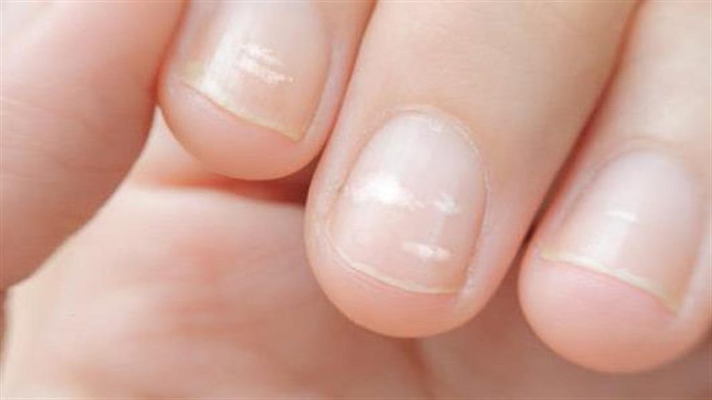 Λευκές κηλίδες στα νύχια: Από τι προκαλούνται και τι μπορείς να κάνεις