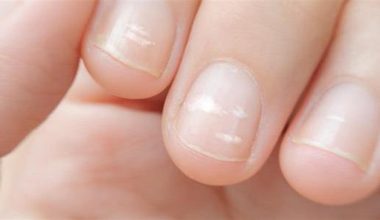 Λευκές κηλίδες στα νύχια: Από τι προκαλούνται και τι μπορείς να κάνεις