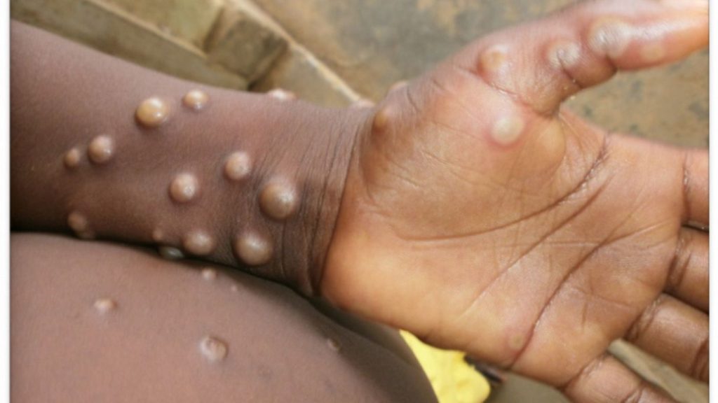 ΠΟΥ: «Είναι απίθανο η έξαρση της ευλογιάς των πιθήκων να οδηγήσει σε πανδημία»