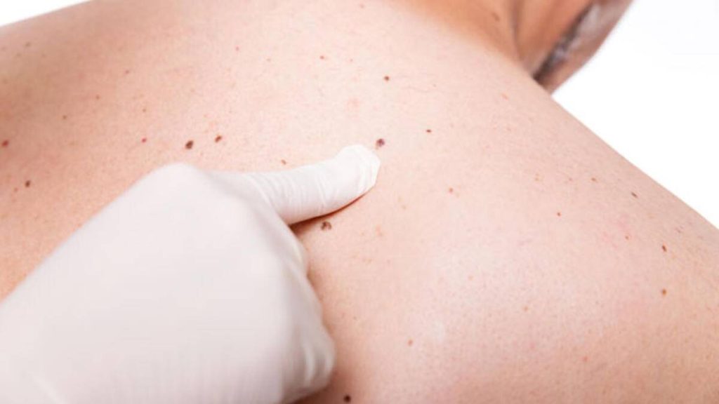 Σημάδια στο δέρμα: Δέκα «αθώα» συμπτώματα στην επιδερμίδα δείχνουν πως κάτι δεν πάει καλά με την υγεία μας