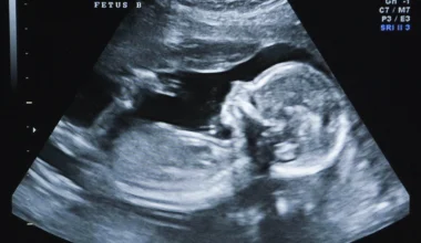 Βίντεο-σοκ: Έτσι διαμελίζουν  το  ζωντανό έμβρυο κατά την διάρκεια  της έκτρωσης
