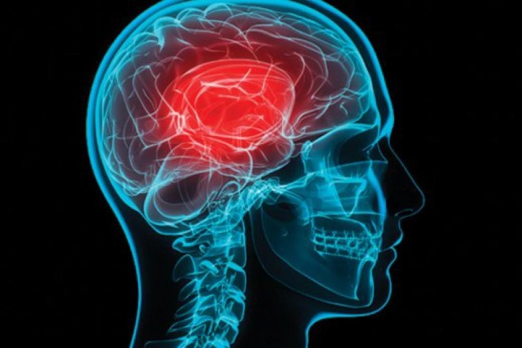 Εγκεφαλικό: Αυτός είναι ο αδιάγνωστος παράγοντας κινδύνου που αφορά το 67% των ασθενών
