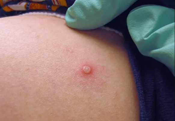 Πρόεδρος του ΕΟΔΥ: «Δεν γνωρίζουμε την προέλευση του 7ου κρούσματος ευλογιάς των πιθήκων»