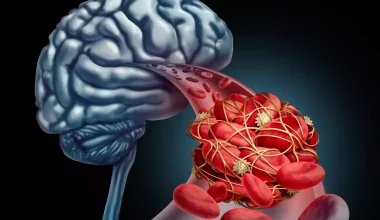 Ανεύρυσμα στον εγκέφαλο: Δέκα «ύπουλα» συμπτώματα που δεν πρέπει να αγνοείτε