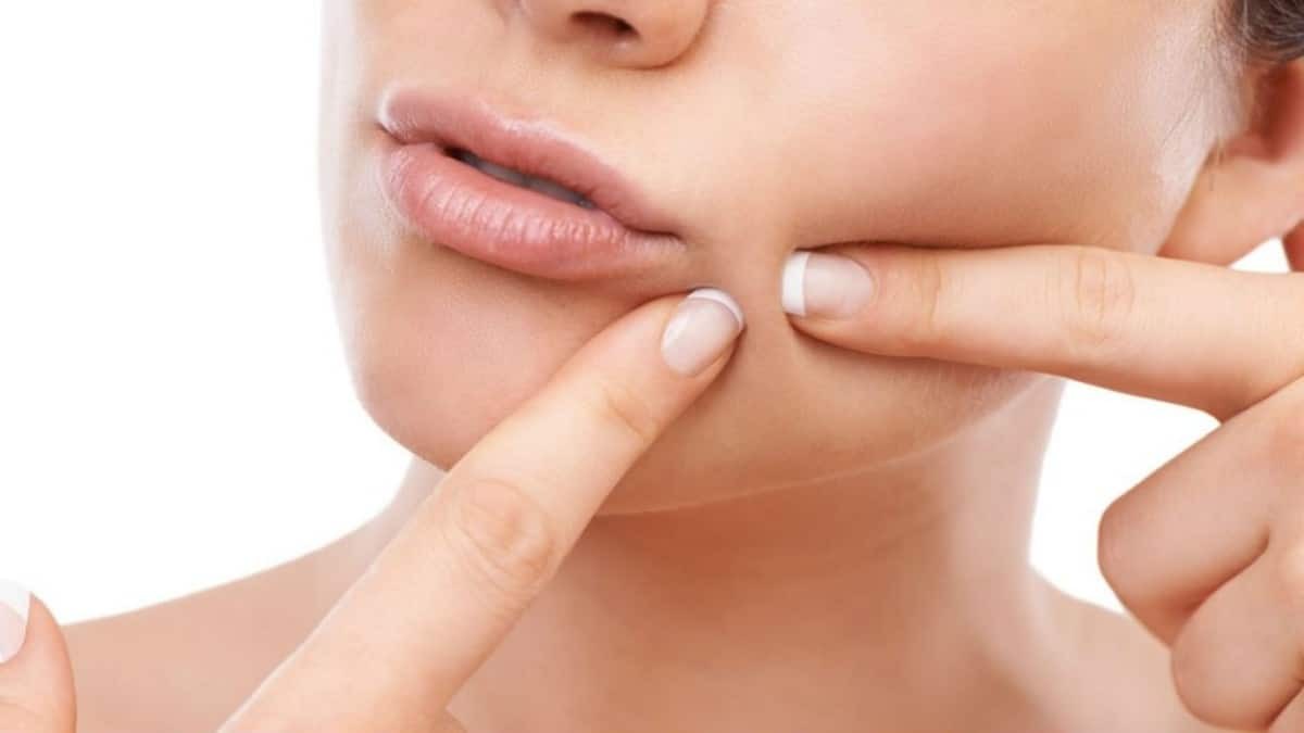 Για να ξέρεις πως να το αντιμετωπίσεις: Ιδού τι κάνουν οι δερματολόγοι όταν βγάζουν σπυράκι