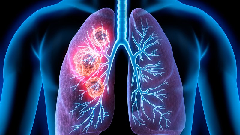 Καρκίνος του πνεύμονα: Πόσο γρήγορα και σε ποια όργανα μπορεί να εξαπλωθεί