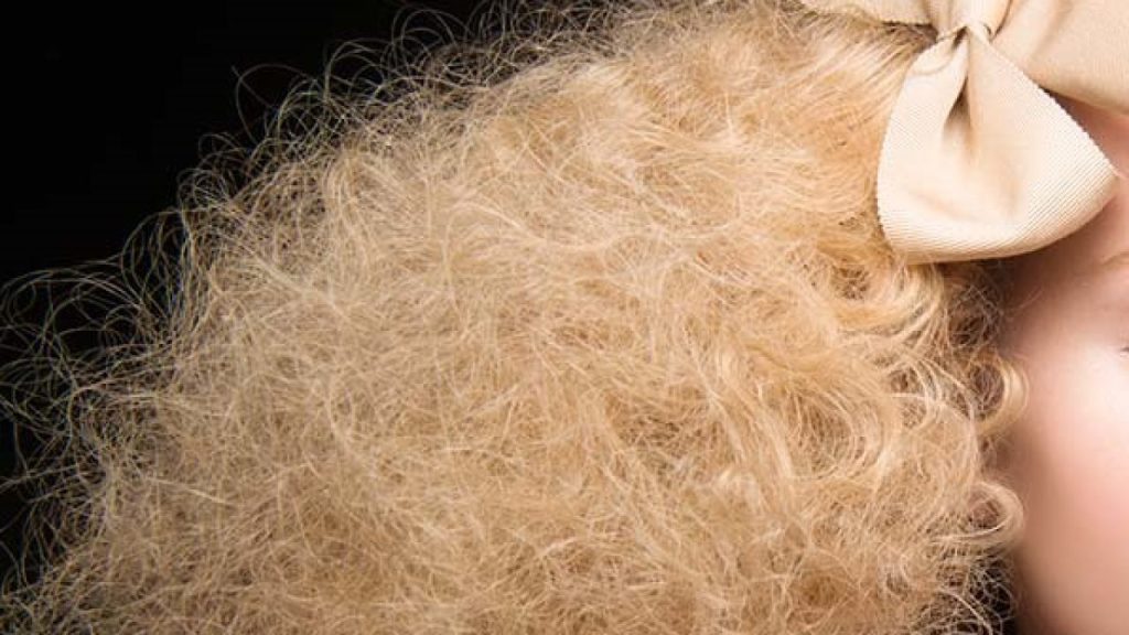 Η μικρή Λέιλα Ντέβιτς από την Αγγλία πάσχει από το σπάνιο σύνδρομο των αχτένιστών μαλλιών (φωτο)