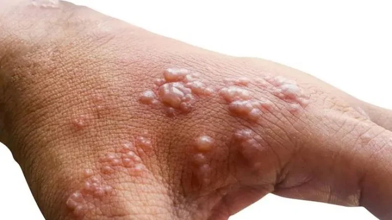 Ευλογιά των πιθήκων: Ήρθε ο πρώτος θάνατος και στην Ευρώπη – Στην Ισπανία το πρώτο θύμα