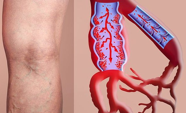 Ποιοι διατρέχουν αυξημένο κίνδυνο να υποστούν θρόμβωση στη διάρκεια του ταξιδιού – Πώς μπορούν να  προστατευθούν