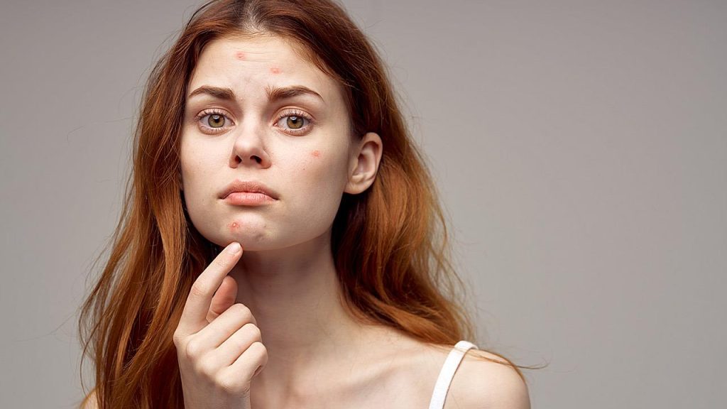 Όσα πρέπει να γνωρίζετε για την ενήλικη ακμή – Γιατί συμβαίνει & τι επιπτώσεις έχει