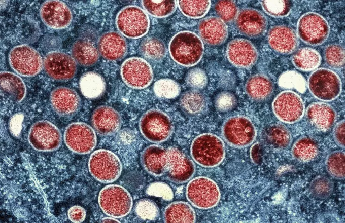 Ισραήλ: 36χρονος πέθανε από ναιγλερίαση που προκλήθηκε από μια σπάνια αμοιβάδα – Του «έφαγε» τον εγκέφαλο