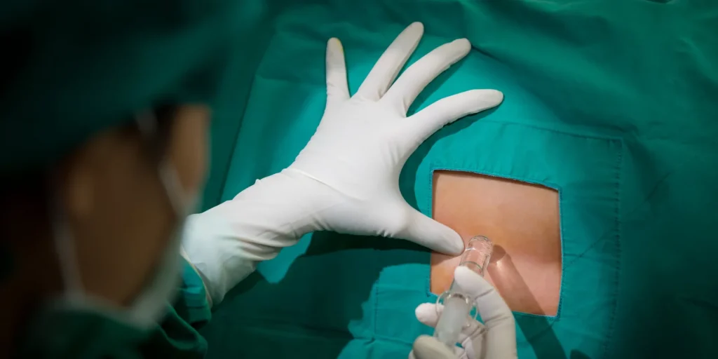 Το viral βίντεο που δείχνει πόσο μεγάλη είναι τελικά η βελόνα που χρησιμοποιείται στην επισκληρίδιο