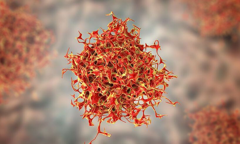 Αυτοί είναι οι κυριότεροι παράγοντες κινδύνου για καρκίνο – Τι ισχύει για άνδρες και γυναίκες