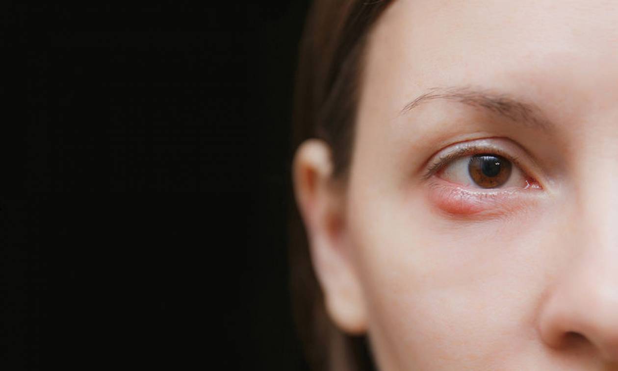 Κριθαράκι στο μάτι: 3+1 φυσικοί τρόποι για να του πείτε άμεσα «αντίο»