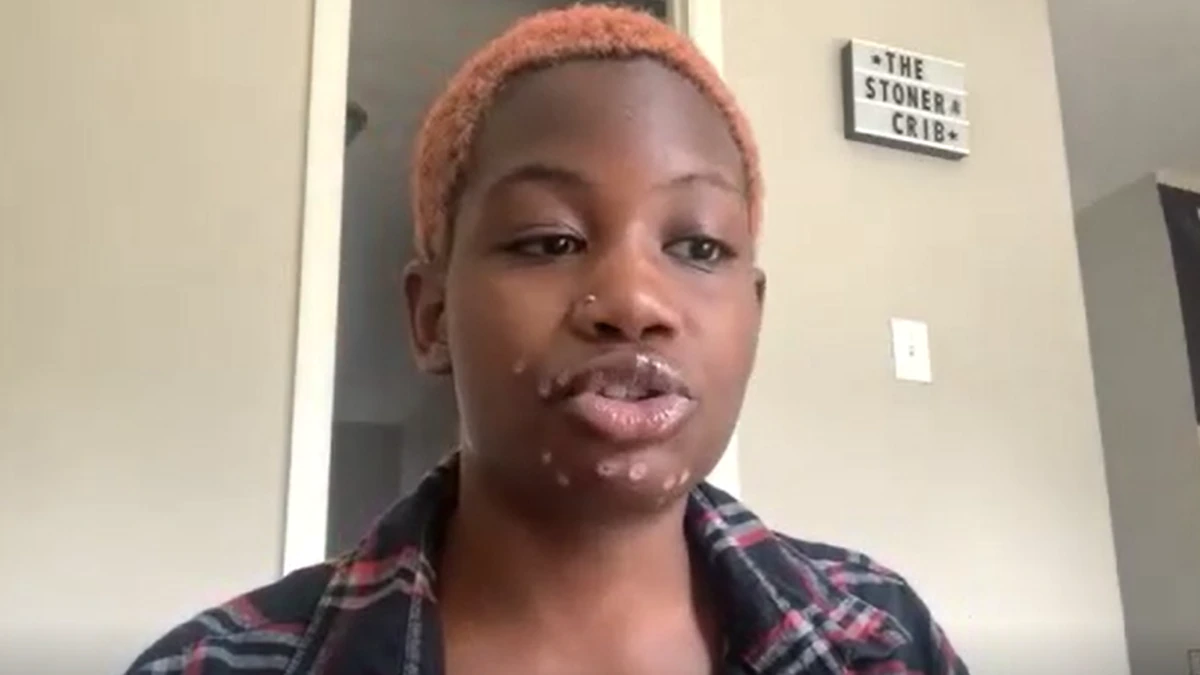 20χρονη με ευλογιά των πιθήκων: «Είχα τρομερό πόνο και λιποθυμίες»