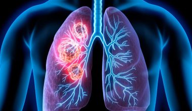 Το νούμερο ένα σύμπτωμα καρκίνου του πνεύμονα που οι περισσότεροι δεν του δίνουν σημασία εγκαίρως