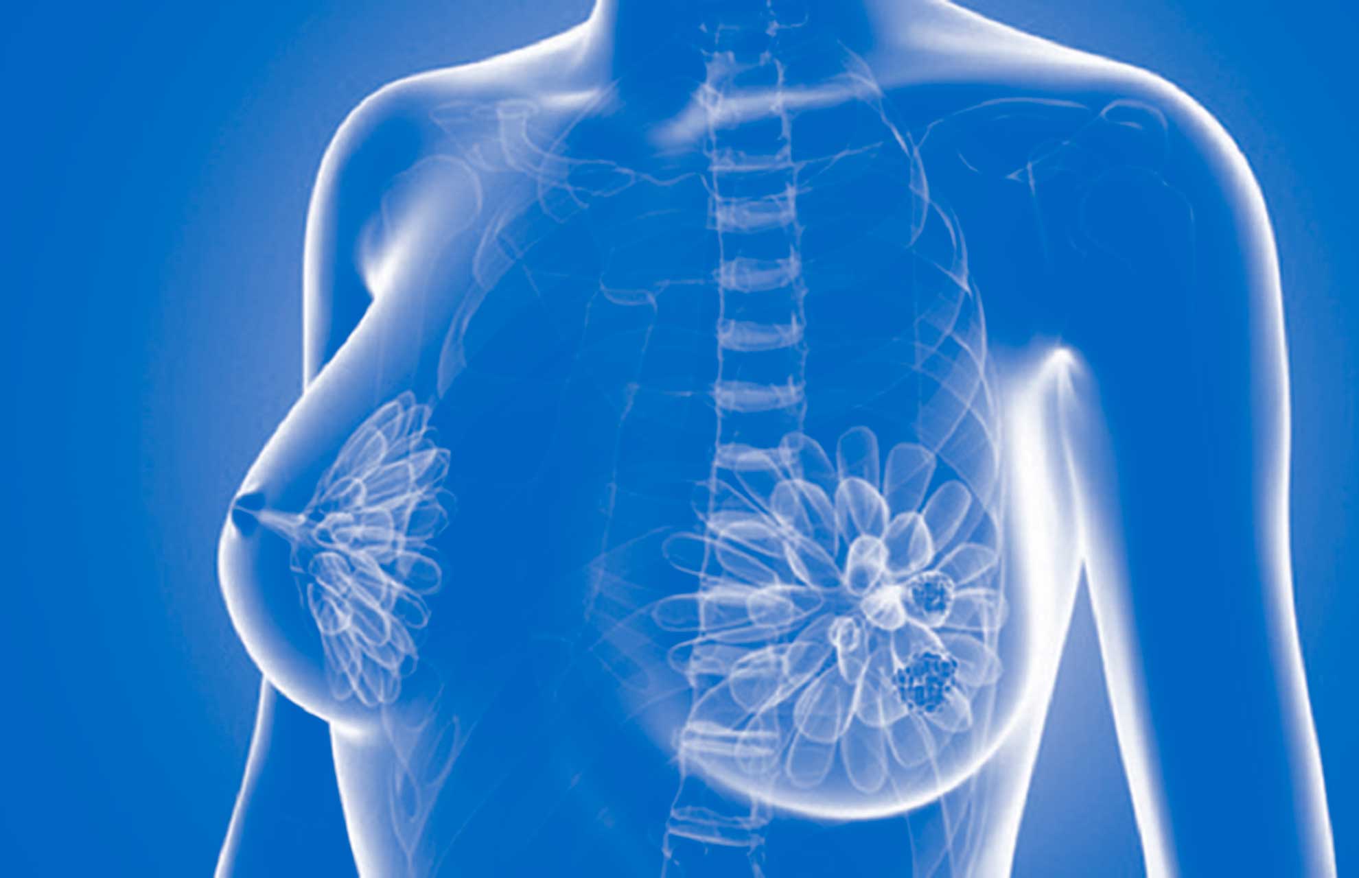 Γιατροί αρνήθηκαν σε νεαρή γυναίκα να κάνει μαστογραφία και λίγο αργότερα διαγνώστηκε με καρκίνο (φωτο)