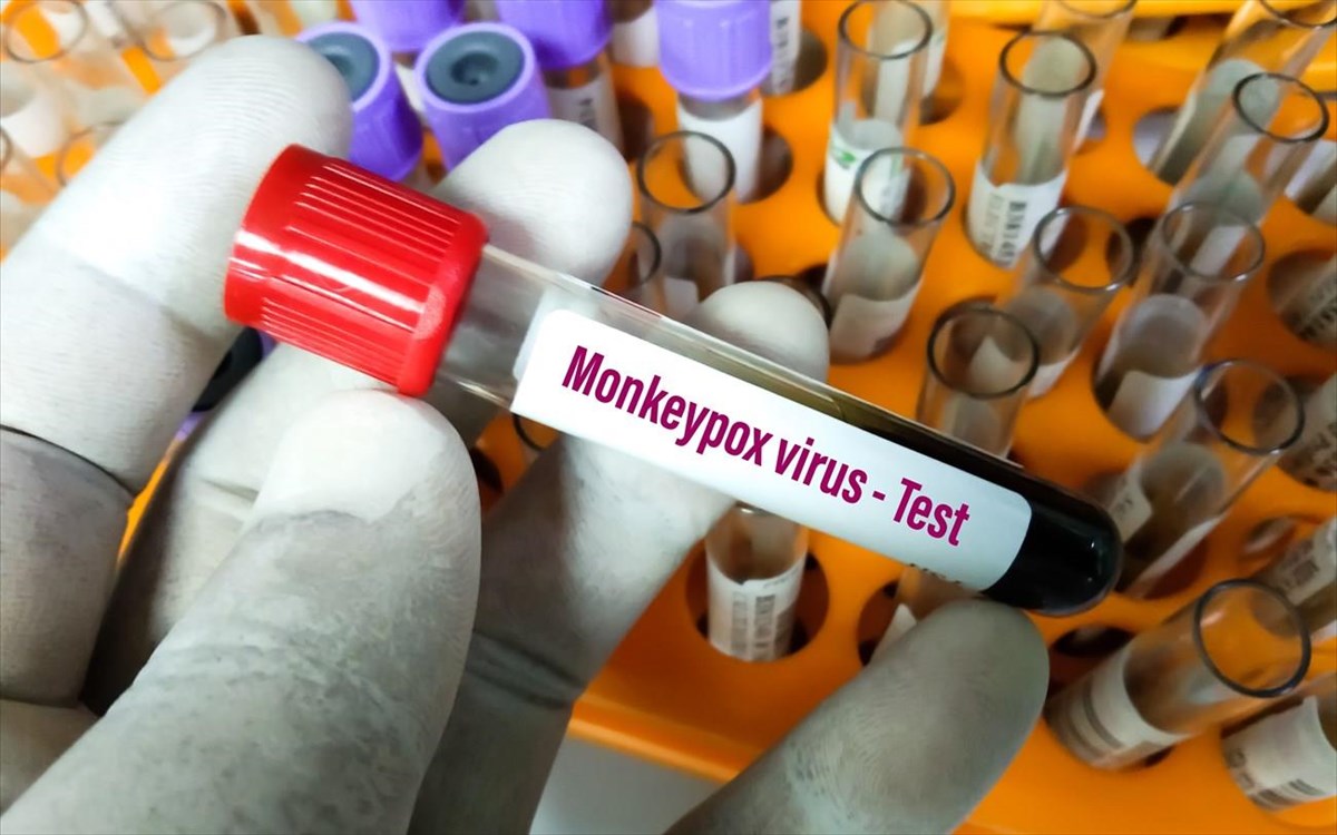 Η ευλογιά των πιθήκων μπορεί να προκαλέσει οφθαλμολογικά προβλήματα