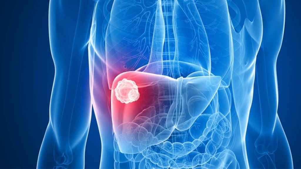 Αυτό είναι το σύμπτωμα καρκίνου του ήπατος που παραβλέπεται πιο συχνά