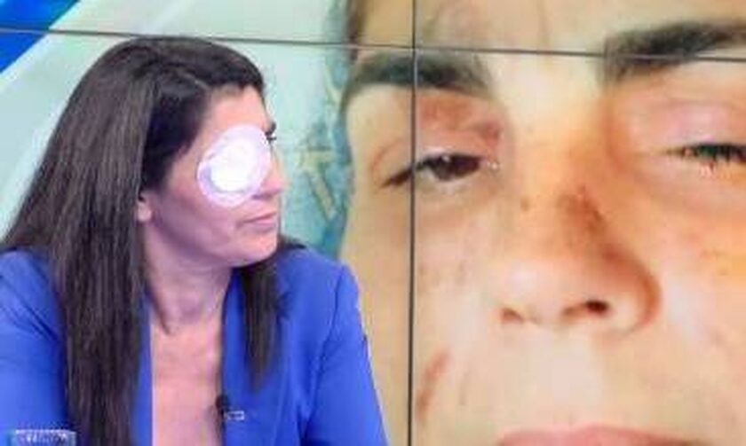 Επίθεση με οξύ στη Μεσσήνη: «Ήταν σαν να μου είχαν βάλει φωτιά» – Περιγράφει η 49χρονη