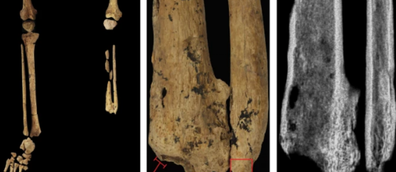 Ανακαλύφθηκε η αρχαιότερη ένδειξη ακρωτηριασμού ανθρώπινου ποδιού πριν 31.000 χρόνια