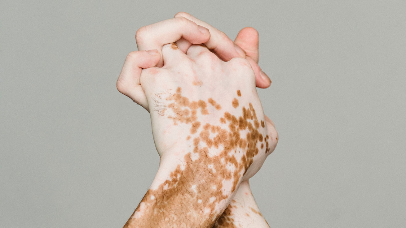 Όλα όσα πρέπει να γνωρίζετε για τη λεύκη: Πώς ξεκινά & ποια είναι τα σημάδια και τα συμπτώματά της