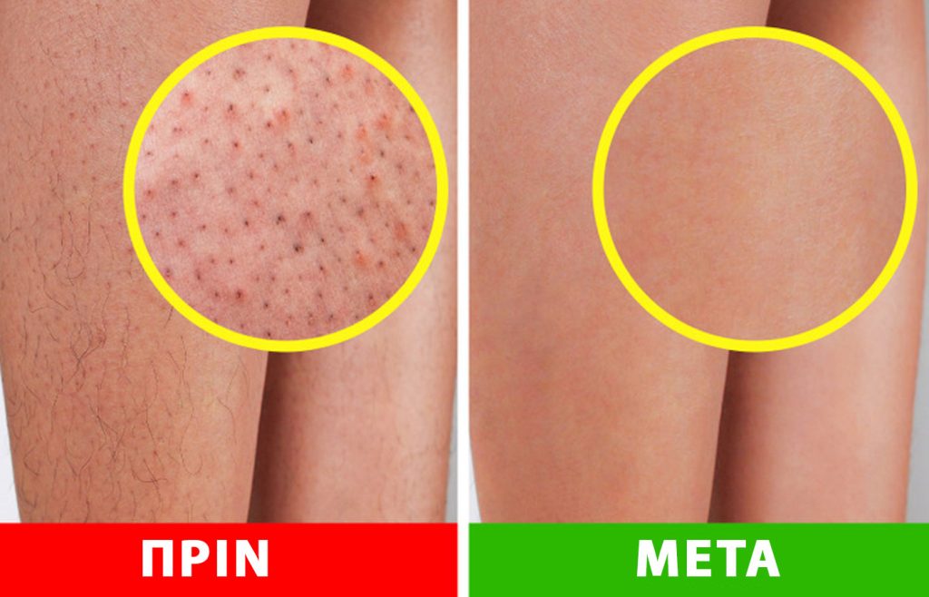 Όσα πρέπει να ξέρετε για τα «πόδια φράουλας» – Πώς να πείτε «αντίο» στις σκούρες κηλίδες